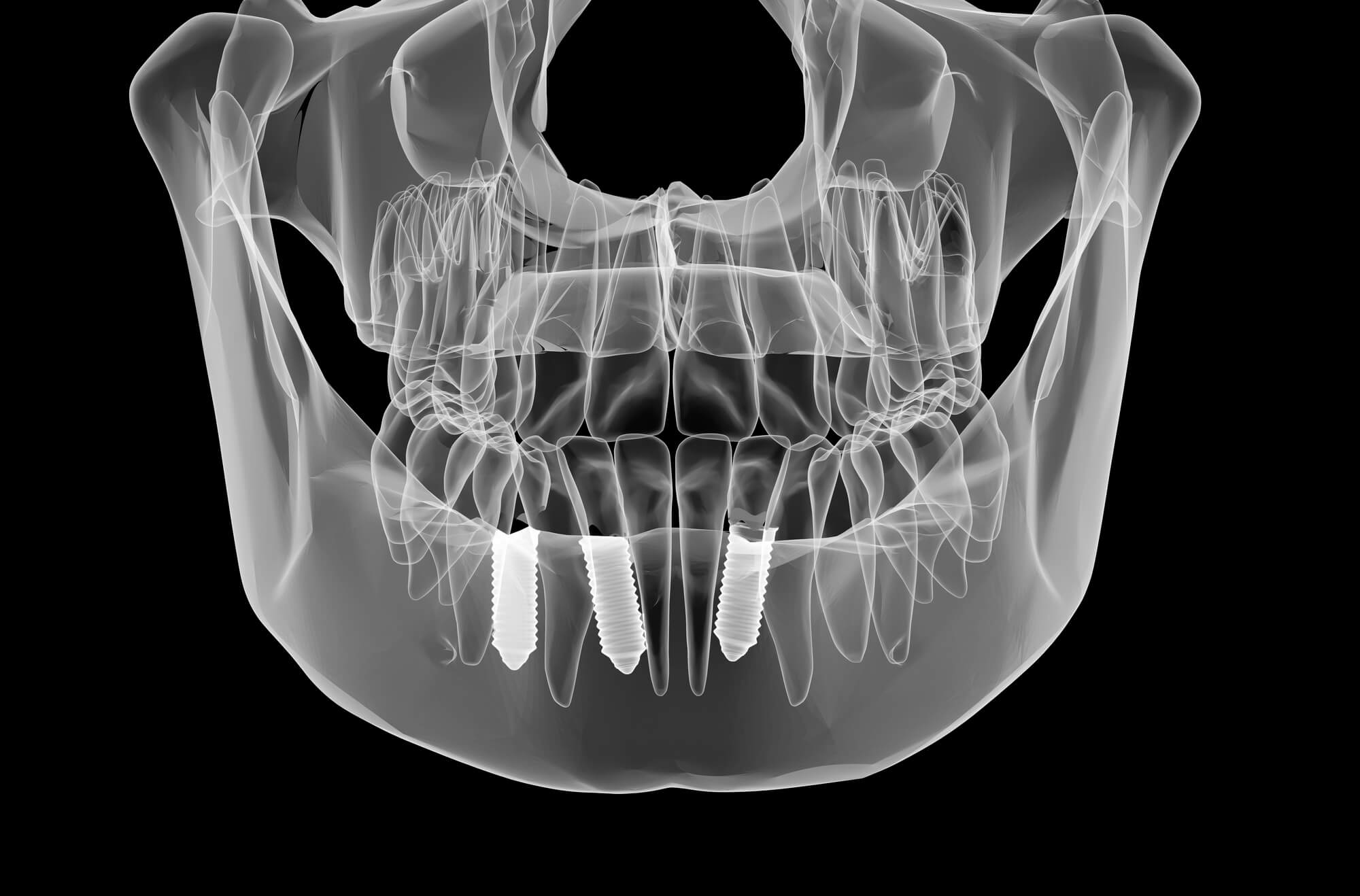 Myths About Dental Implants Village Square Dental