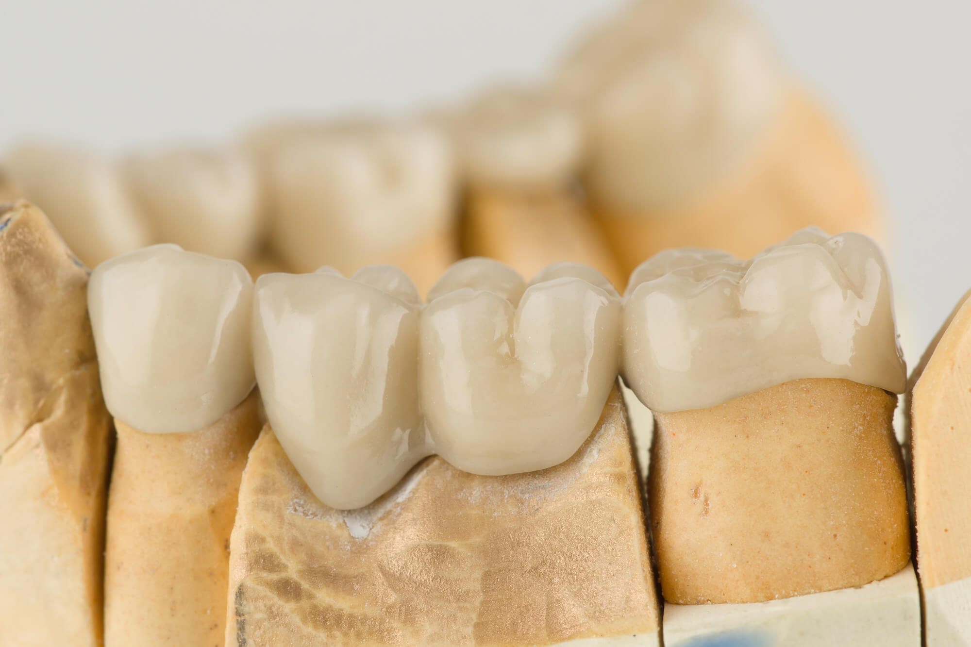 Benefits of Dental Implants Over Bridges Village Square Dental