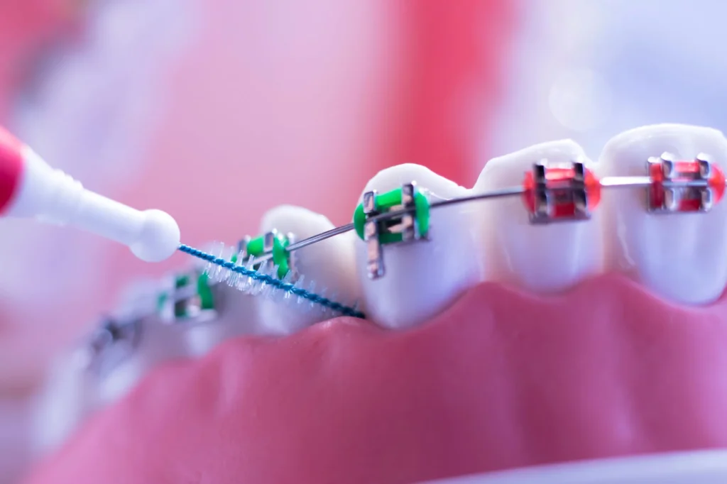 Floss-with-Braces-in-Pembroke-Pines