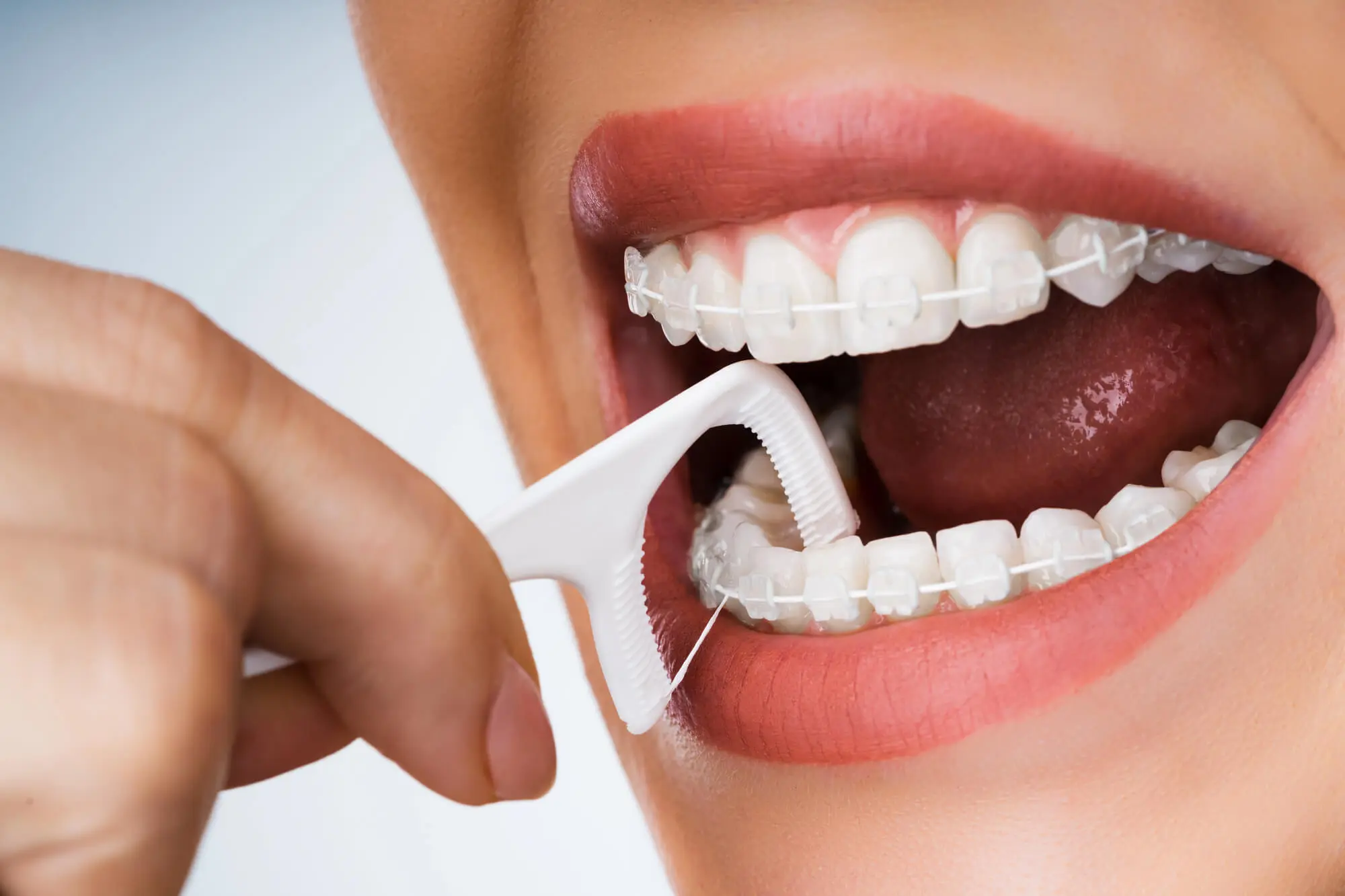 How-to-Keep-Your-Braces-in-Pembroke-Pines-Clean