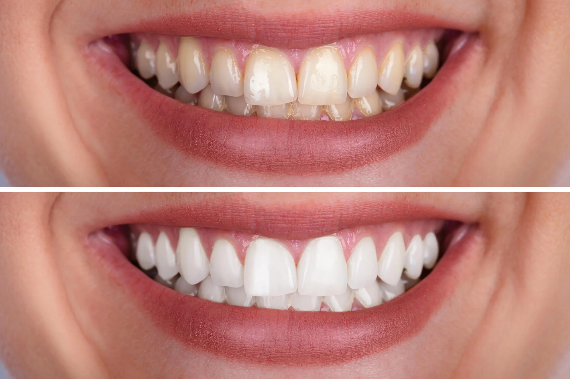 before and after whitening process teeth whitening