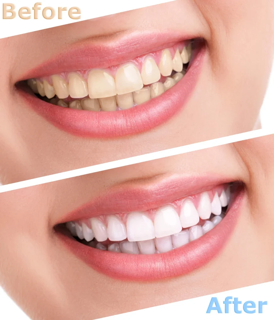 Before and after comparison of a smile showing yellow teeth transformed into bright white teeth after treatment. Teeth whitening in Pembroke Pines