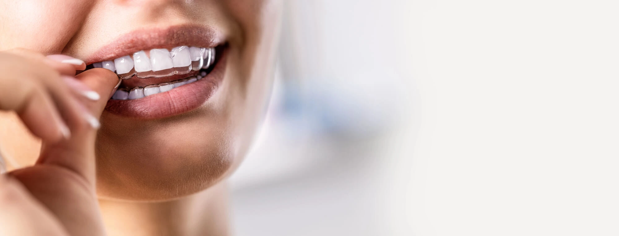 Woman-Wearing-Clear-Aligners-for-Invisalign-Pembroke-Pines