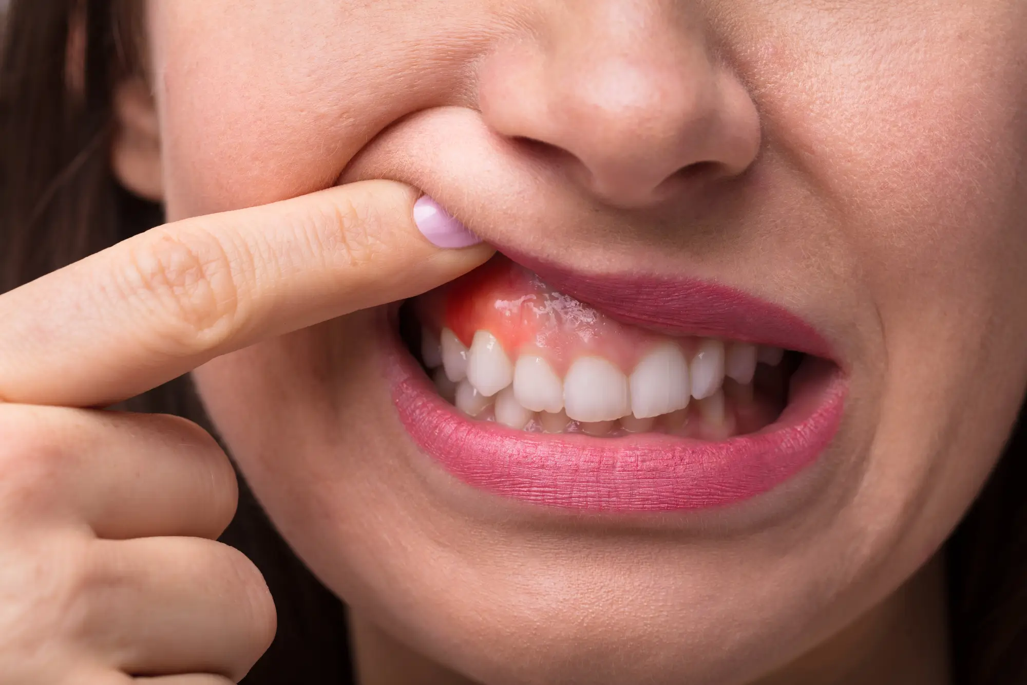 Swollen Gum Exam by Periodontist Pembroke Pines