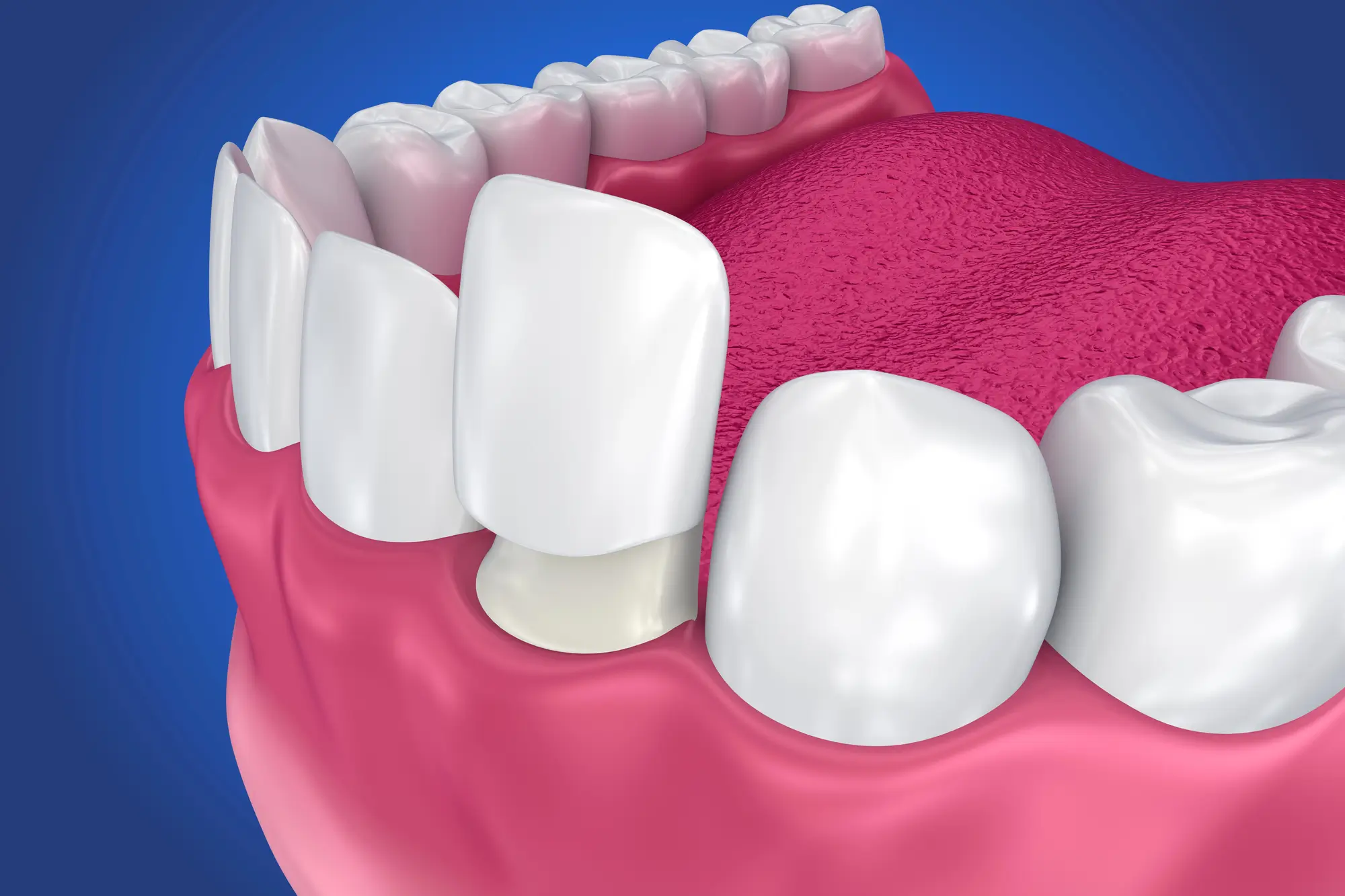 Porcelain Veneers at Dentist in Miramar