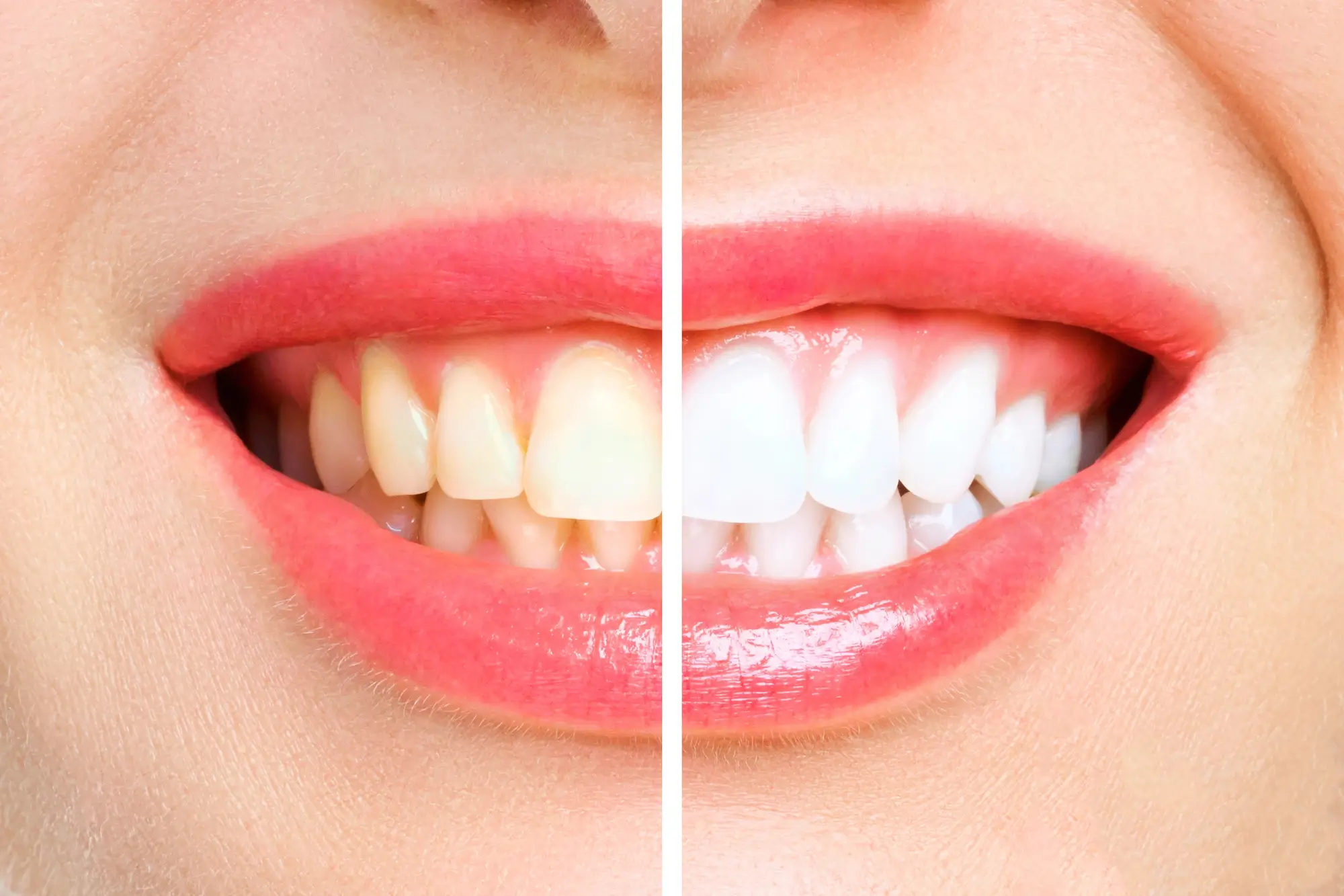 Woman showing teeth before and after teeth whitening in Pembroke Pines